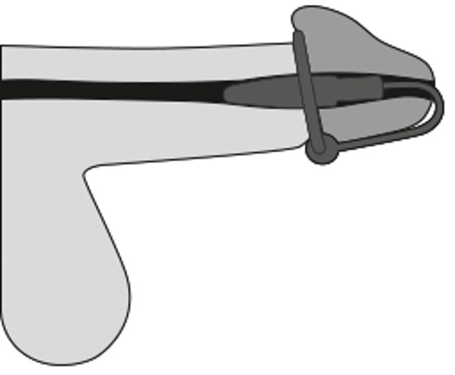 Glans Ring and Dilator